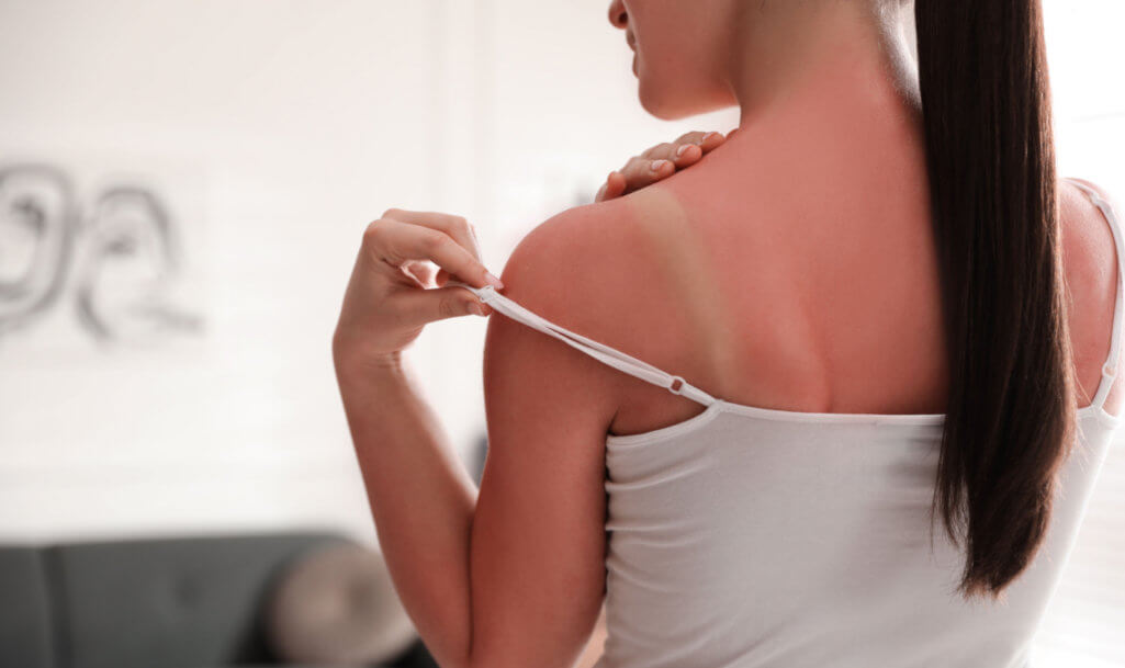 Woman with sunburned skin at home, closeup