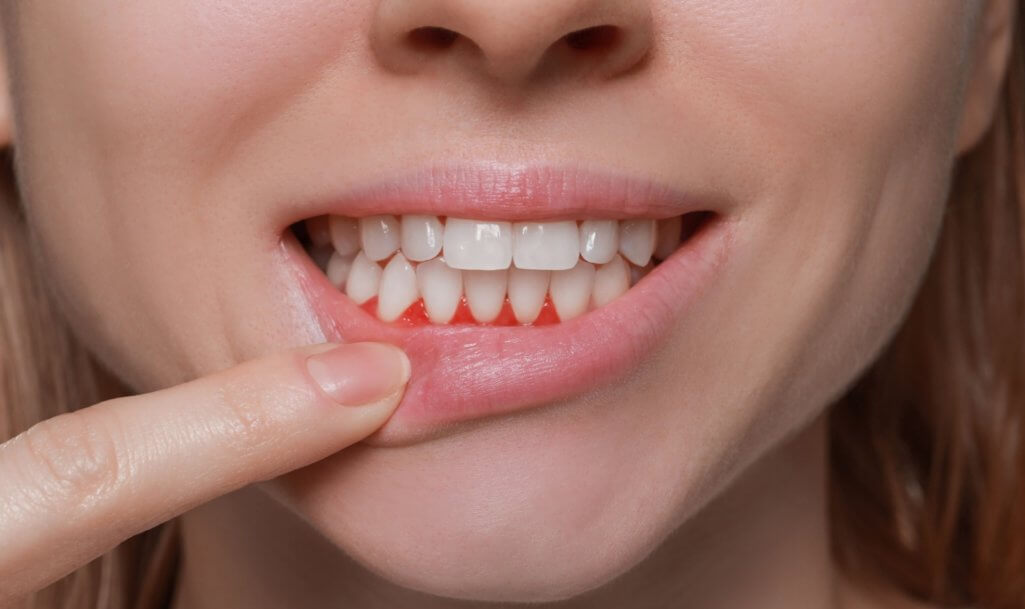 Woman showing inflamed gum, closeup. Oral cavity health