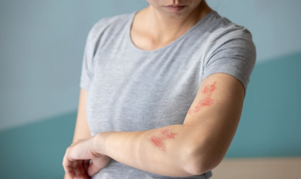 Woman with shingles on the skin she feels very painful